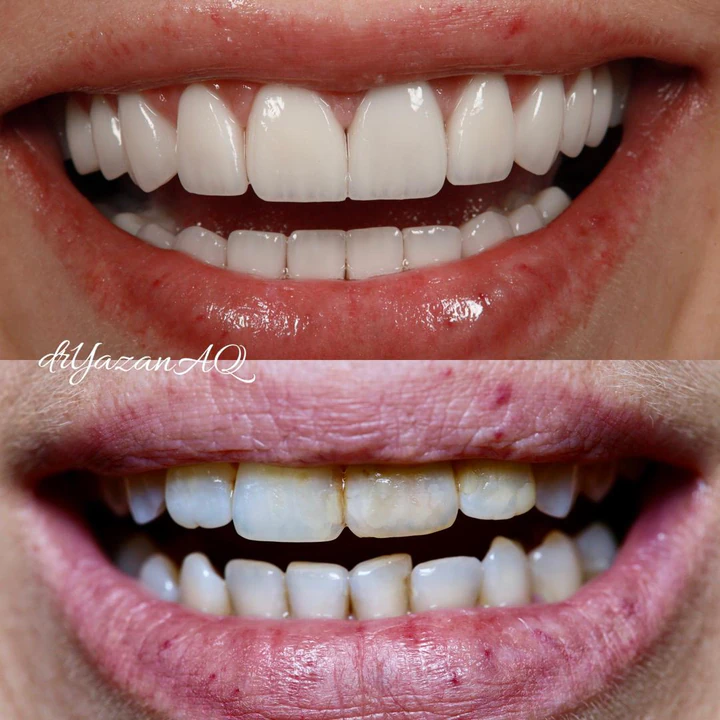 Caz Before & After realizat de Dr. Yazan Aq.