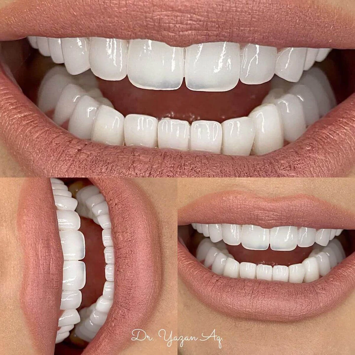 Caz Before & After realizat de Dr. Yazan Aq.