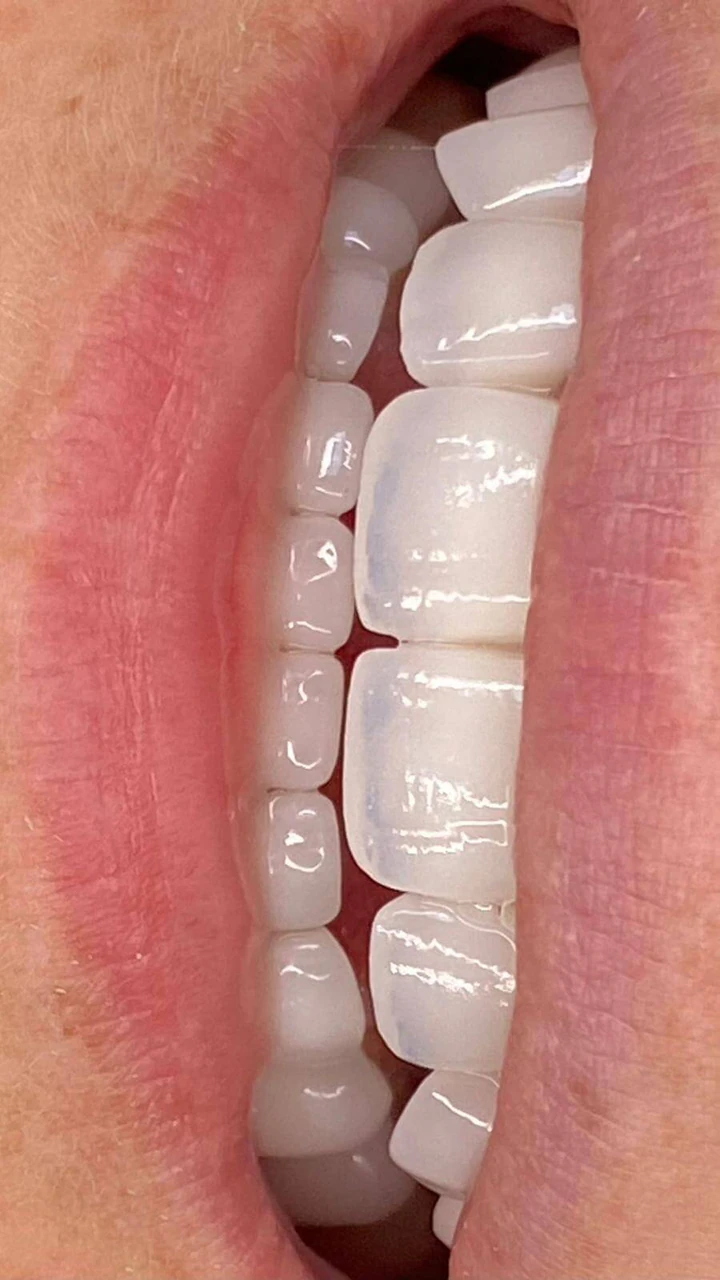 Caz Before & After realizat de Dr. Yazan Aq.