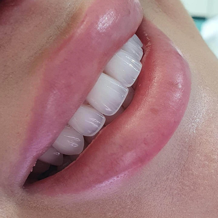 Caz Before & After realizat de Dr. Yazan Aq.