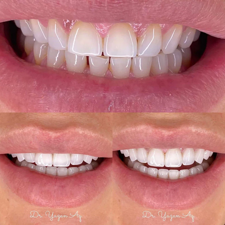 Caz Before & After realizat de Dr. Yazan Aq.