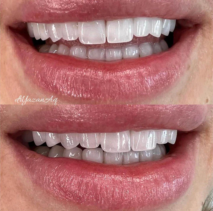 Caz Before & After realizat de Dr. Yazan Aq.