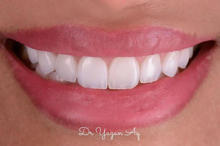 Caz Before & After realizat de Dr. Yazan Aq.