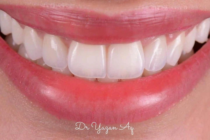 Caz Before & After realizat de Dr. Yazan Aq.