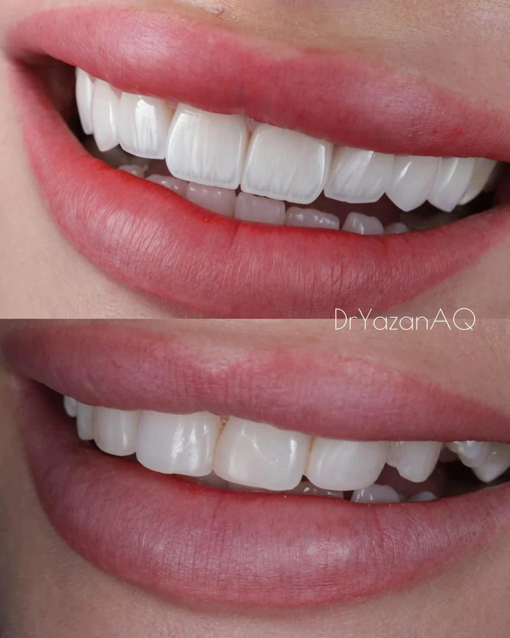Caz Before & After realizat de Dr. Yazan Aq.