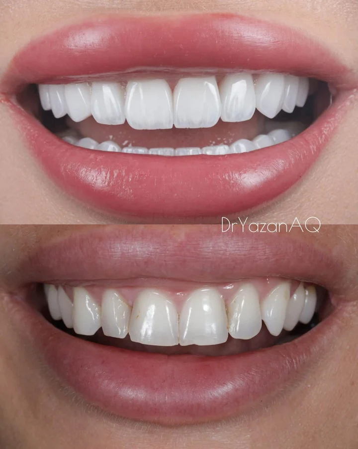 Caz Before & After realizat de Dr. Yazan Aq.