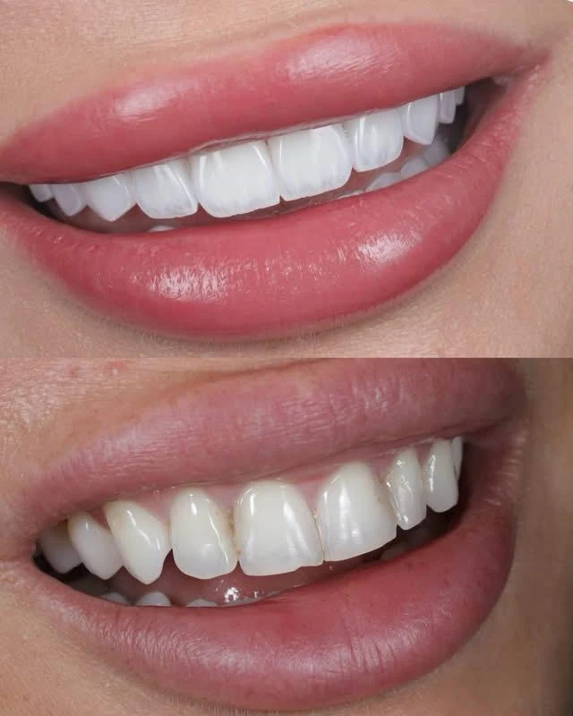 Caz Before & After realizat de Dr. Yazan Aq.