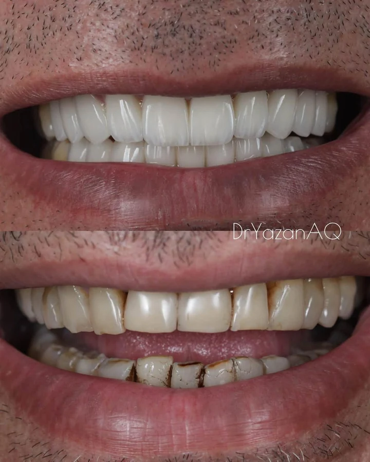 Caz Before & After realizat de Dr. Yazan Aq.