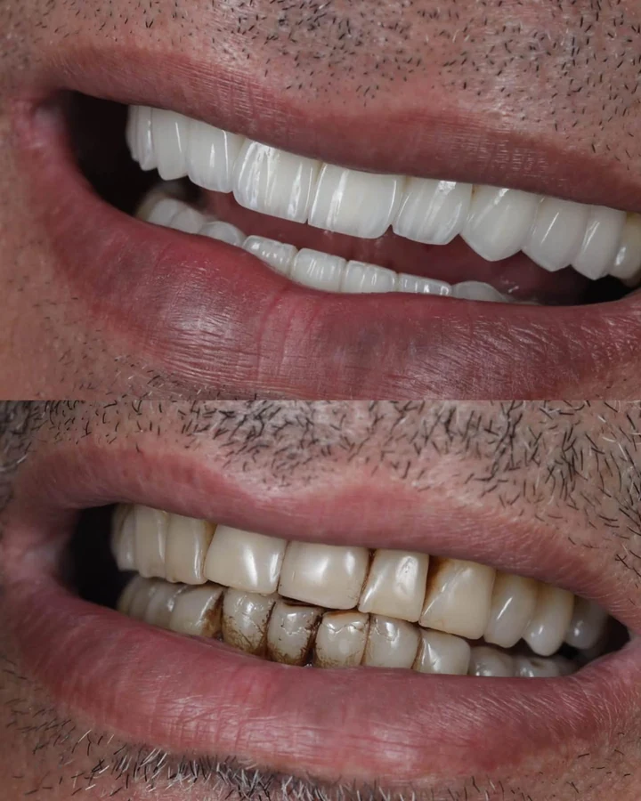 Caz Before & After realizat de Dr. Yazan Aq.
