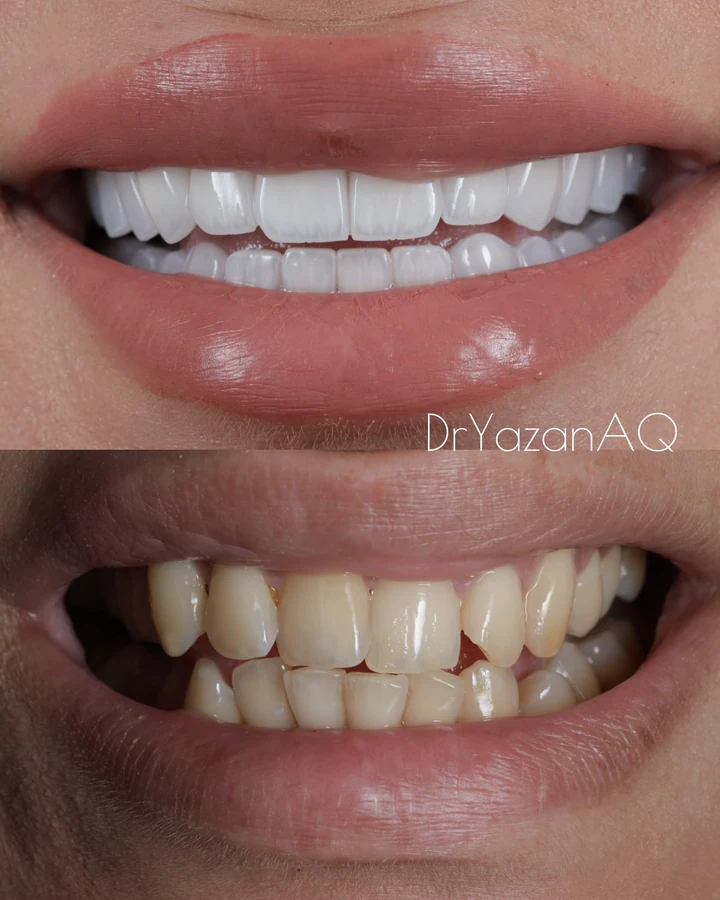 Caz Before & After realizat de Dr. Yazan Aq.