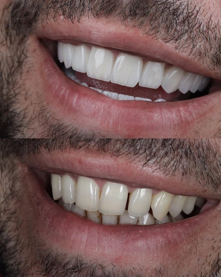 Caz Before & After realizat de Dr. Yazan Aq.