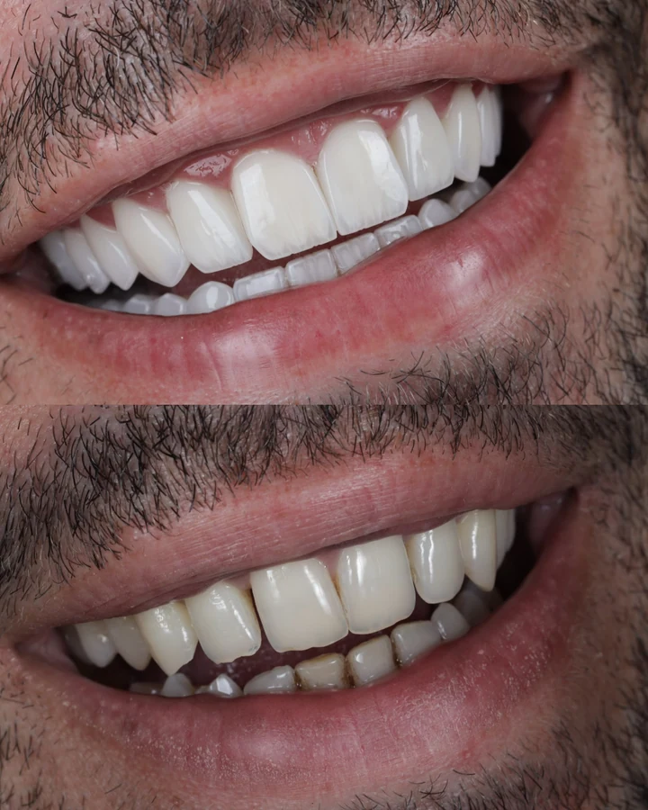 Caz Before & After realizat de Dr. Yazan Aq.