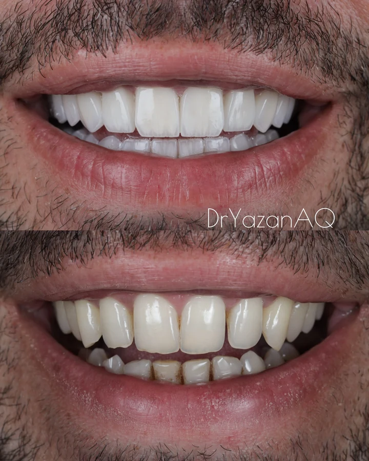 Caz Before & After realizat de Dr. Yazan Aq.