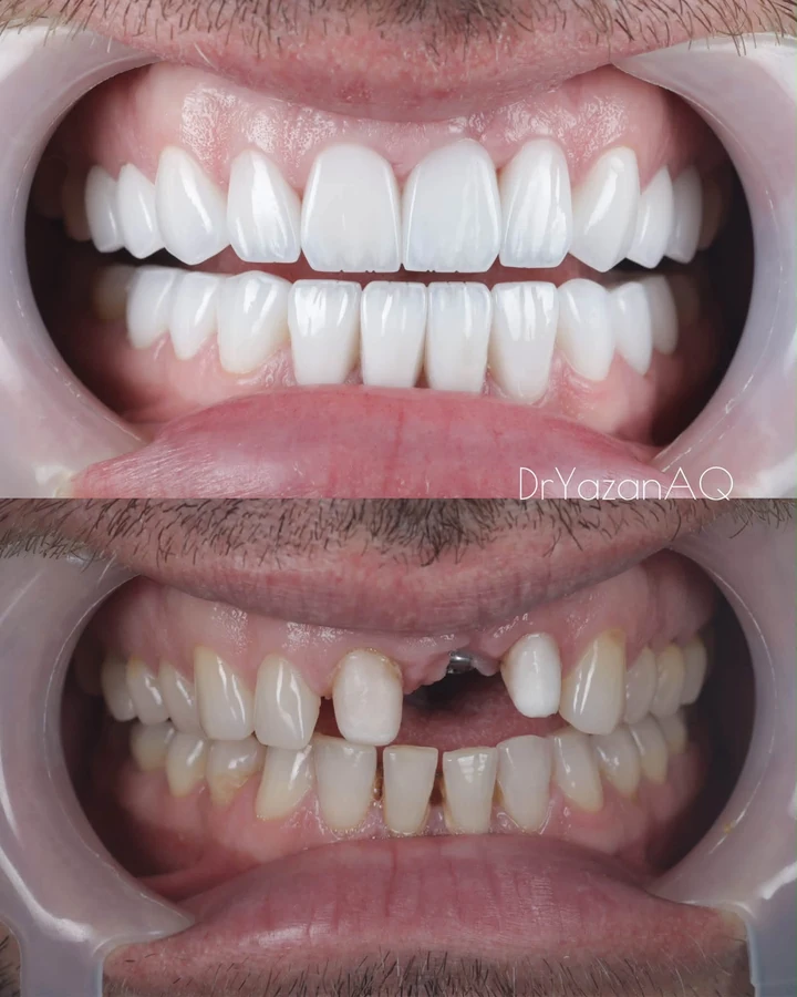 Comparație după și înainte: implant frontal și fațete personalizate, detaliu frontal