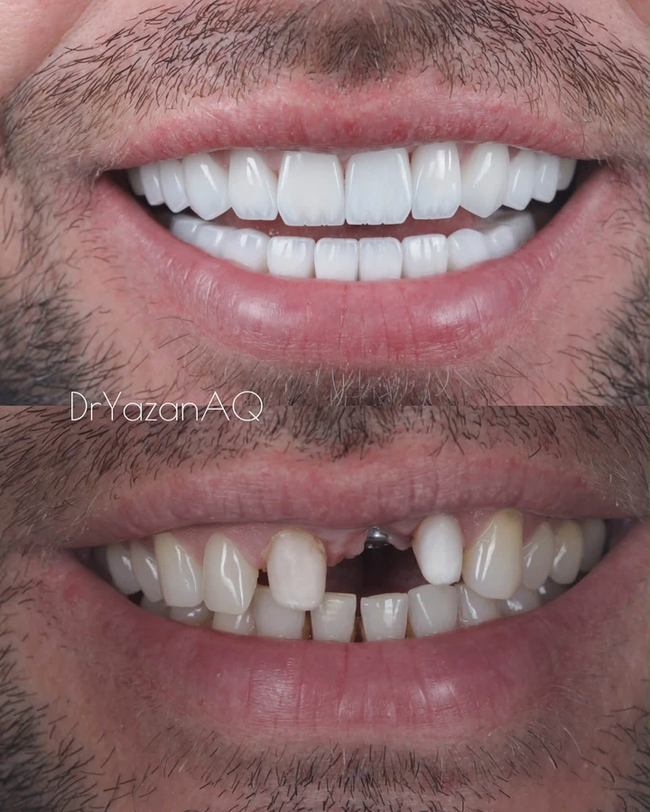Comparație după și înainte: implant frontal și fațete personalizate, zâmbet frontal