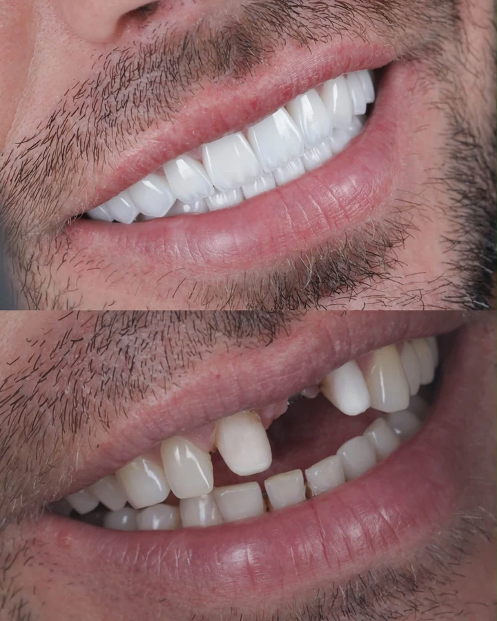 Comparație după și înainte: implant frontal și fațete personalizate, zâmbet lateral