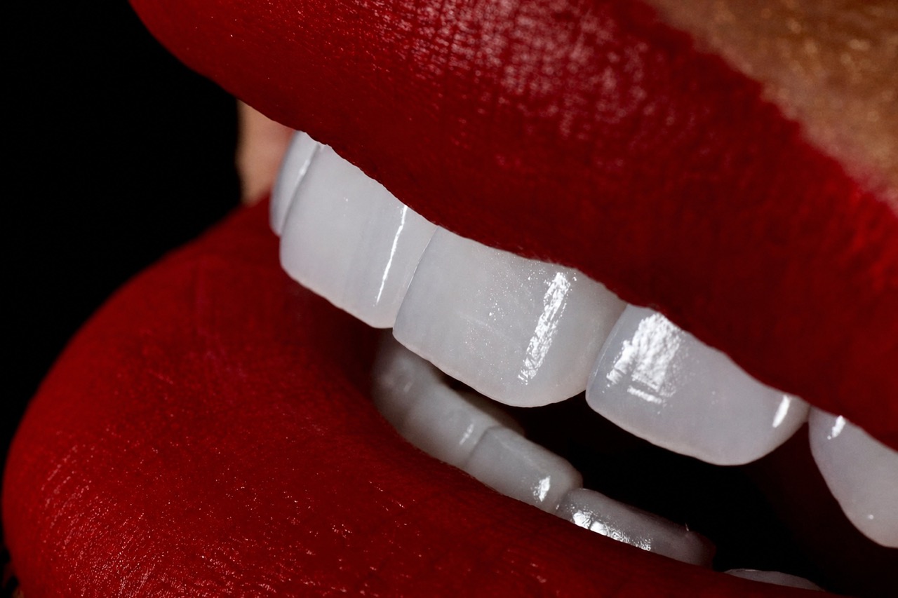Natural-looking smile with dental veneers by Dr. Yazan Aq.