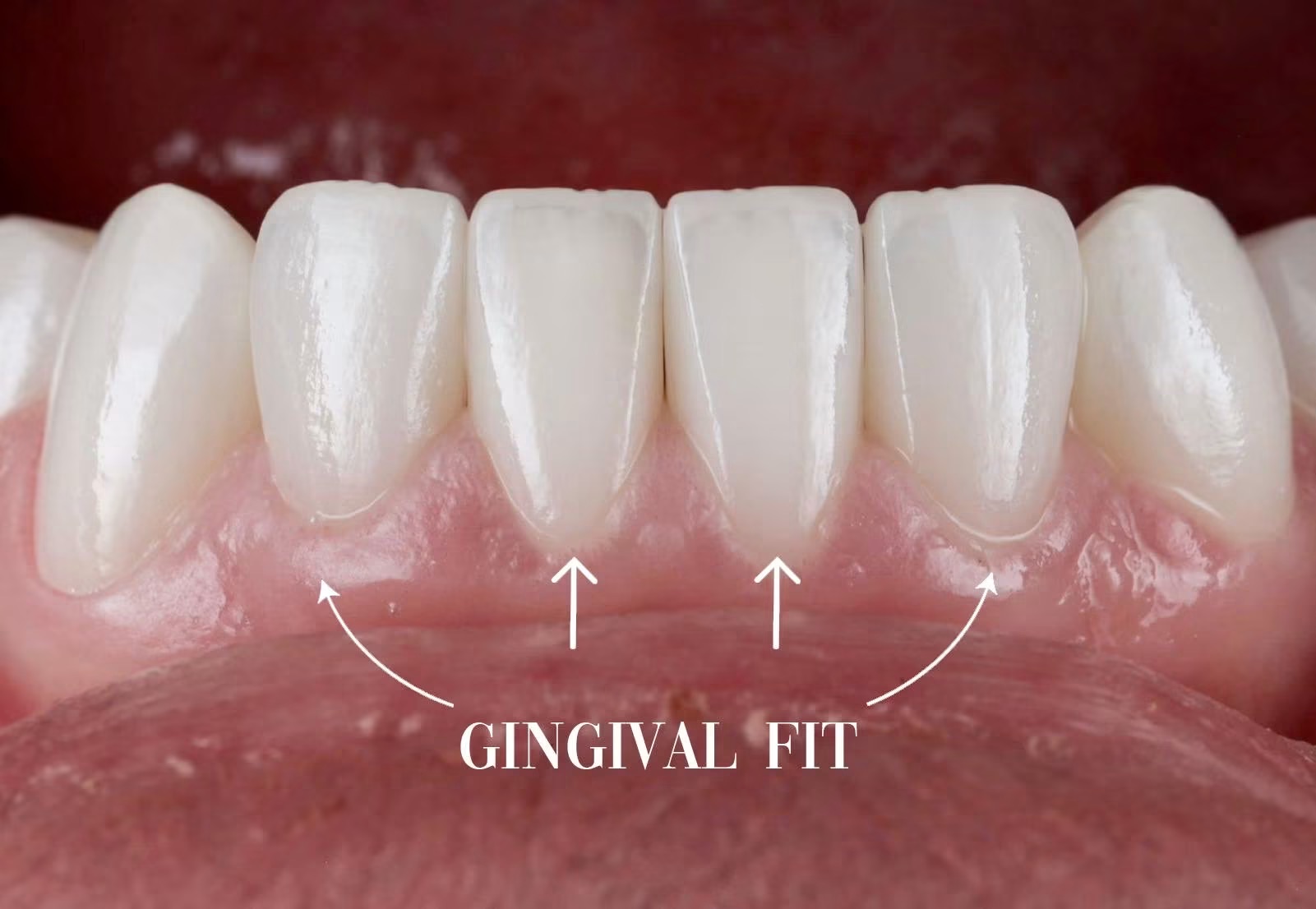 Contur gingival într-un caz real realizat de Dr. Yazan Aq.