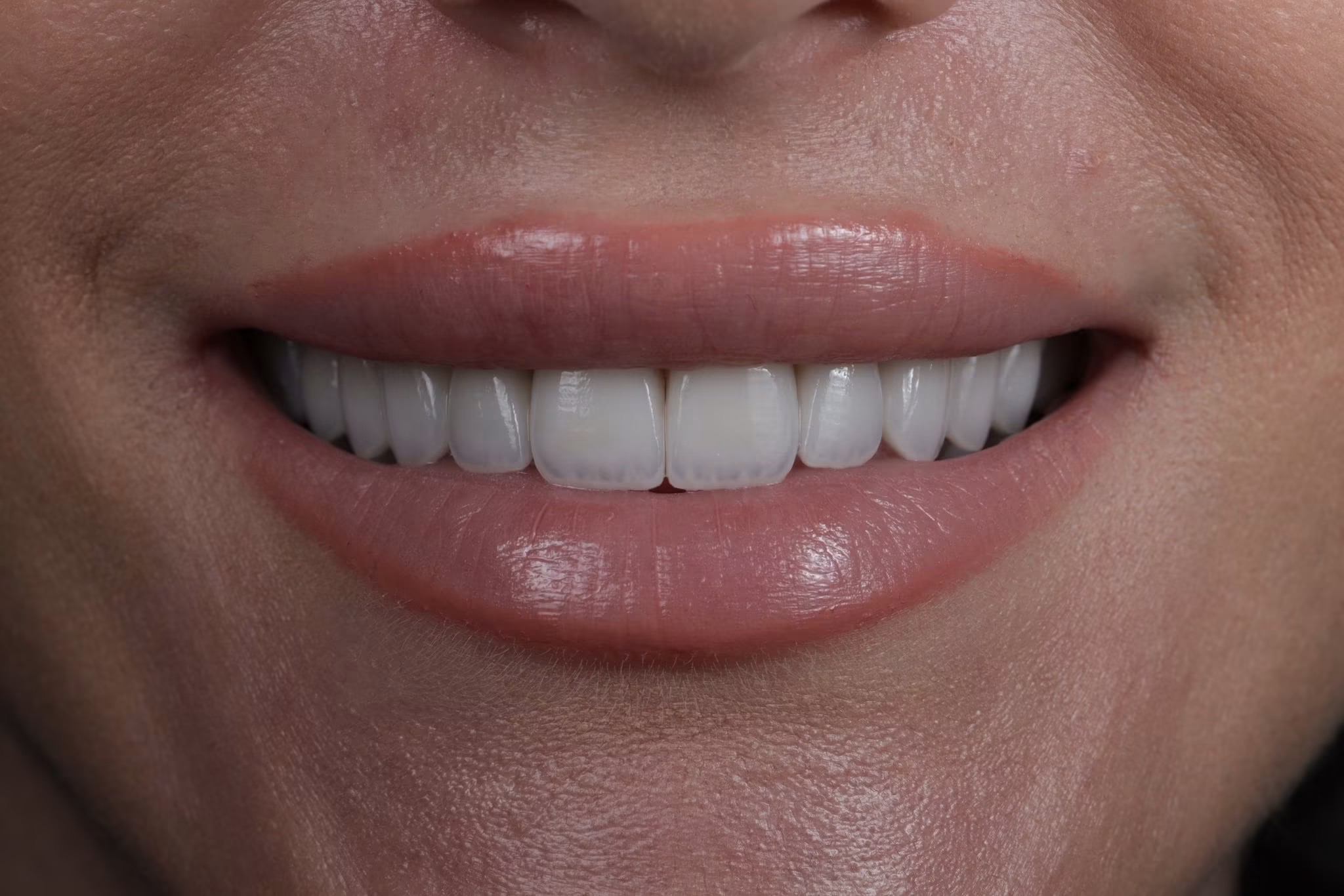 Aesthetic dental result by Dr. Yazan Aq.