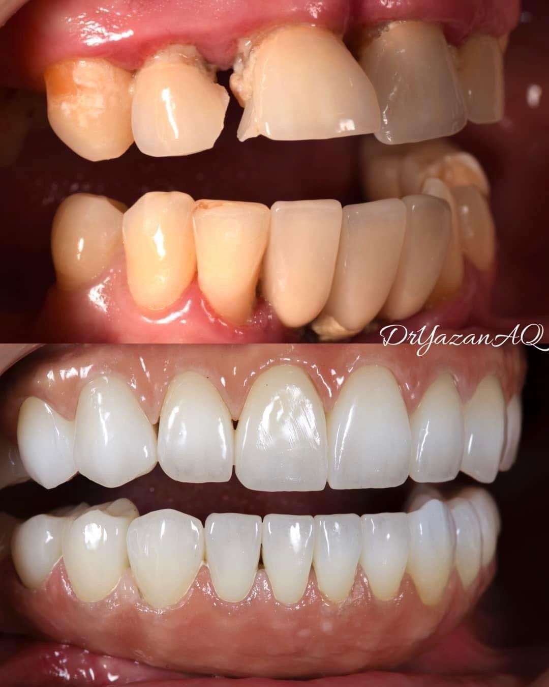 Dental implants and the Fast & Fixed solution