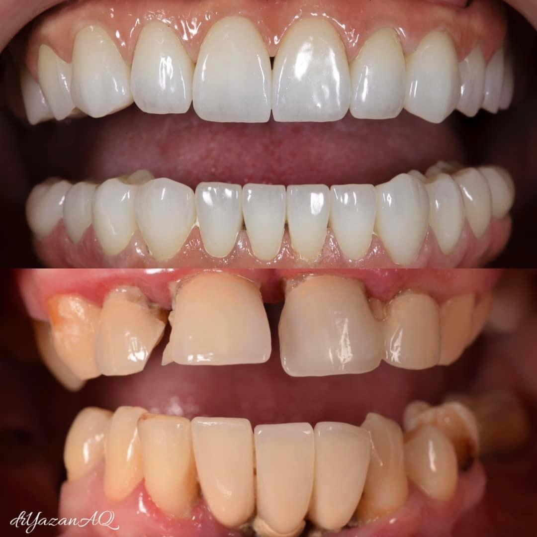 Dental implant procedure