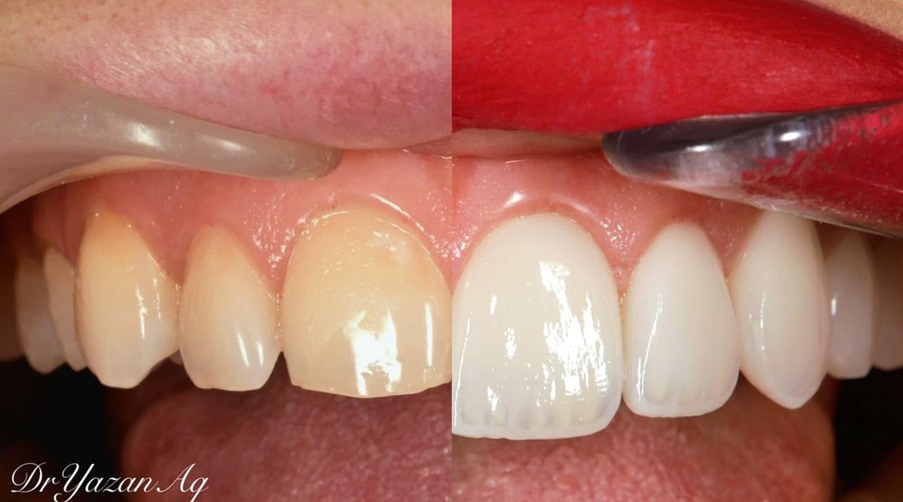 E-max ceramic dental veneers by Dr. Yazan Aq.