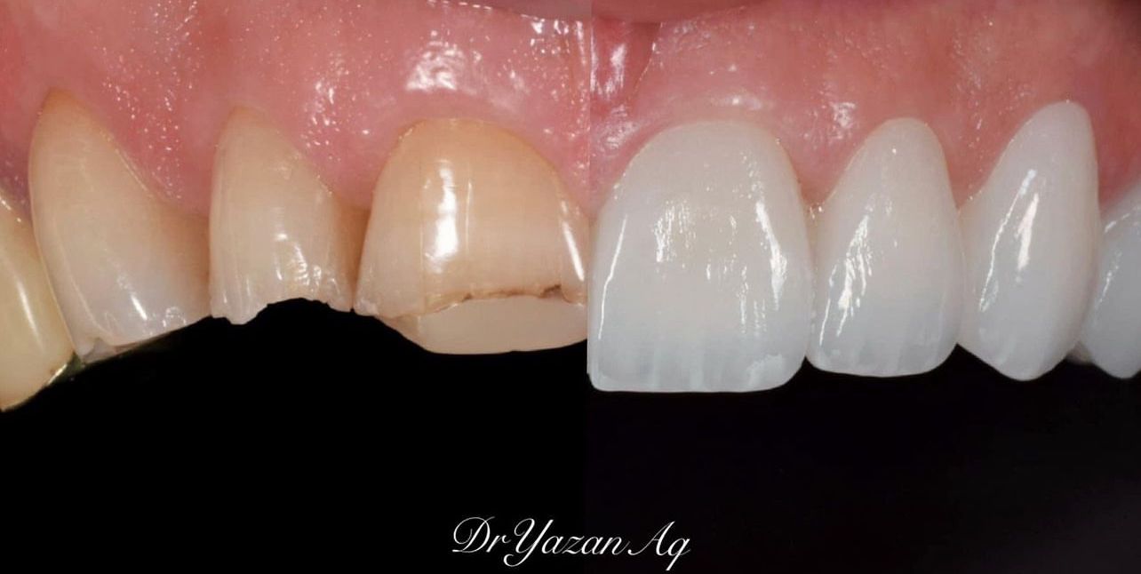 Before and after comparison of dental veneers